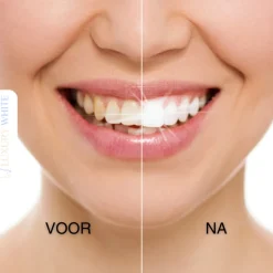 Luxury White Whitening Strips